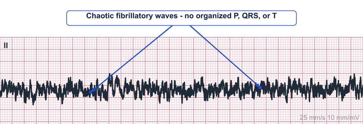 Annotated rhythm strip: arrows mark the chaotic fibrillatory waveline with no organized P waves, QRS complexes, or T waves.