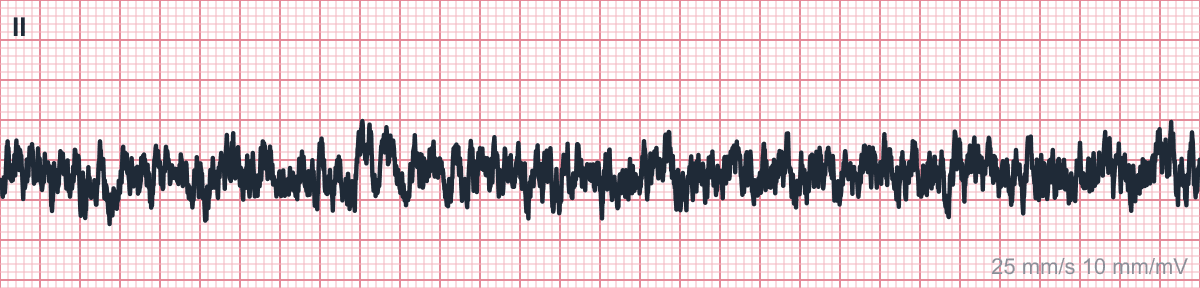 Six-second single-lead (lead II) rhythm strip on standard ECG paper at 25 mm/s and 10 mm/mV.
